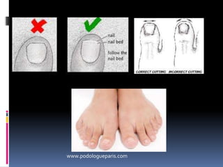 BunionsA bunion is when your big toe points toward the second toe. This causes a bump on the inside edge of your toe.Athlete’s footknown as dermatophytosis of the foot or tineapedis ("foot fungus"), is a common skin infection that affects the feet. You don't have to be an "athlete" to get it.www.ehow.com