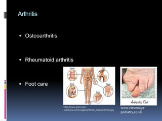 Bones are fully developed except for the heel, growth is rapid until puberty and tight shoes still a danger.18-20 years old-The bones are hardened but continue to change and the rate of change may be due some factors like:Weight gain
