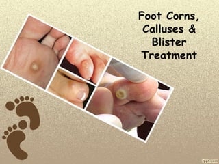 Foot Corns,
Calluses &
Blister
Treatment
 