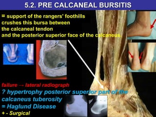 5.2. PRE CALCANEAL BURSITIS
= support of the rangers' foothills
crushes this bursa between
the calcaneal tendon
and the posterior superior face of the calcaneus.
failure → lateral radiograph
? hypertrophy posterior superior part of the
calcaneus tuberosity
= Haglund Disease
+ - Surgical
 