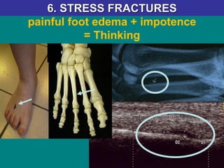 painful foot edema + impotence
= Thinking
6. STRESS FRACTURES
 