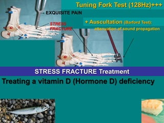 Tuning Fork Test (128Hz)+++
→ EXQUISITE PAIN
attenuation of sound propagation
STRESS
FRACTURE
+ Auscultation (Barford Test):
STRESS FRACTURE Treatment
Treating a vitamin D (Hormone D) deficiency
 