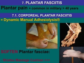 = Dynamic Manual Adhesiolysis®
SOFTEN Plantar fasciae:
- Shiatsu Massage Cushion +++
7.1. CORPOREAL PLANTAR FASCIITIS
7. PLANTAR FASCIITIS
Plantar pain + common in military > 40 years
 