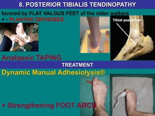 favored by FLAT VALGUS FEET of the older walkers
+ - PLANTAR ORTHOSES
Analgesic TAPING
8. POSTERIOR TIBIALIS TENDINOPATHY
Tibial postérieur
TREATMENT
Dynamic Manual Adhesiolysis®
+ Strengthening FOOT ARCH
 