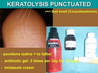 KERATOLYSIS PUNCTUATED
+++ Bad smell (Corynebacterium)
- povidone iodine = to lather
- antibiotic gel: 2 times per day for 15 days
- imidazole cream
 