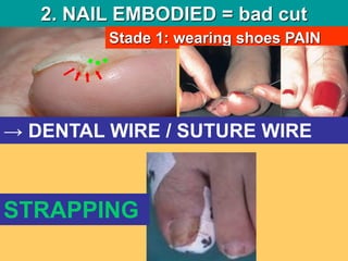 classique = défaut de coupe2. NAIL EMBODIED = bad cut
Stade 1: wearing shoes PAIN
→ DENTAL WIRE / SUTURE WIRE
STRAPPING
 