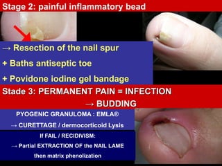 Stage 2: painful inflammatory bead
→ Resection of the nail spur
+ Baths antiseptic toe
+ Povidone iodine gel bandage
Stade 3: PERMANENT PAIN = INFECTION
→ BUDDING
PYOGENIC GRANULOMA : EMLA®
→ CURETTAGE / dermocorticoid Lysis
If FAIL / RECIDIVISM:
→ Partial EXTRACTION OF the NAIL LAME
then matrix phenolization
 