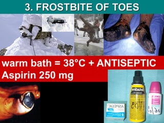3. FROSTBITE OF TOES
warm bath = 38°C + ANTISEPTIC
Aspirin 250 mg
 