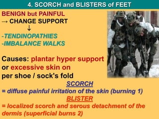 BENIGN but PAINFUL
→ CHANGE SUPPORT

-TENDINOPATHIES
-IMBALANCE WALKS
Causes: plantar hyper support
or excessive skin on
per shoe / sock's fold
SCORCH
= diffuse painful irritation of the skin (burning 1)
BLISTER
= localized scorch and serous detachment of the
dermis (superficial burns 2)
4. SCORCH and BLISTERS of FEET
 