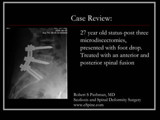 Case Review:
   27 year old status-post three
   microdiscectomies,
   presented with foot drop.
   Treated with an anterior and
   posterior spinal fusion




Robert S Pashman, MD
Scoliosis and Spinal Deformity Surgery
www.eSpine.com
 