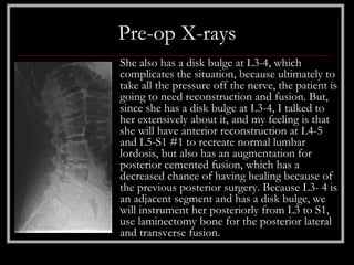 Pre-op X-rays
She also has a disk bulge at L3-4, which
complicates the situation, because ultimately to
take all the pressure off the nerve, the patient is
going to need reconstruction and fusion. But,
since she has a disk bulge at L3-4, I talked to
her extensively about it, and my feeling is that
she will have anterior reconstruction at L4-5
and L5-S1 #1 to recreate normal lumbar
lordosis, but also has an augmentation for
posterior cemented fusion, which has a
decreased chance of having healing because of
the previous posterior surgery. Because L3- 4 is
an adjacent segment and has a disk bulge, we
will instrument her posteriorly from L3 to S1,
use laminectomy bone for the posterior lateral
and transverse fusion.
 