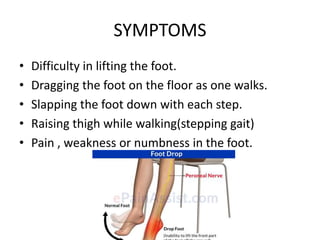 • Difficulty in lifting the foot.
• Dragging the foot on the floor as one walks.
• Slapping the foot down with each step.
• Raising thigh while walking(stepping gait)
• Pain , weakness or numbness in the foot.
SYMPTOMS
 