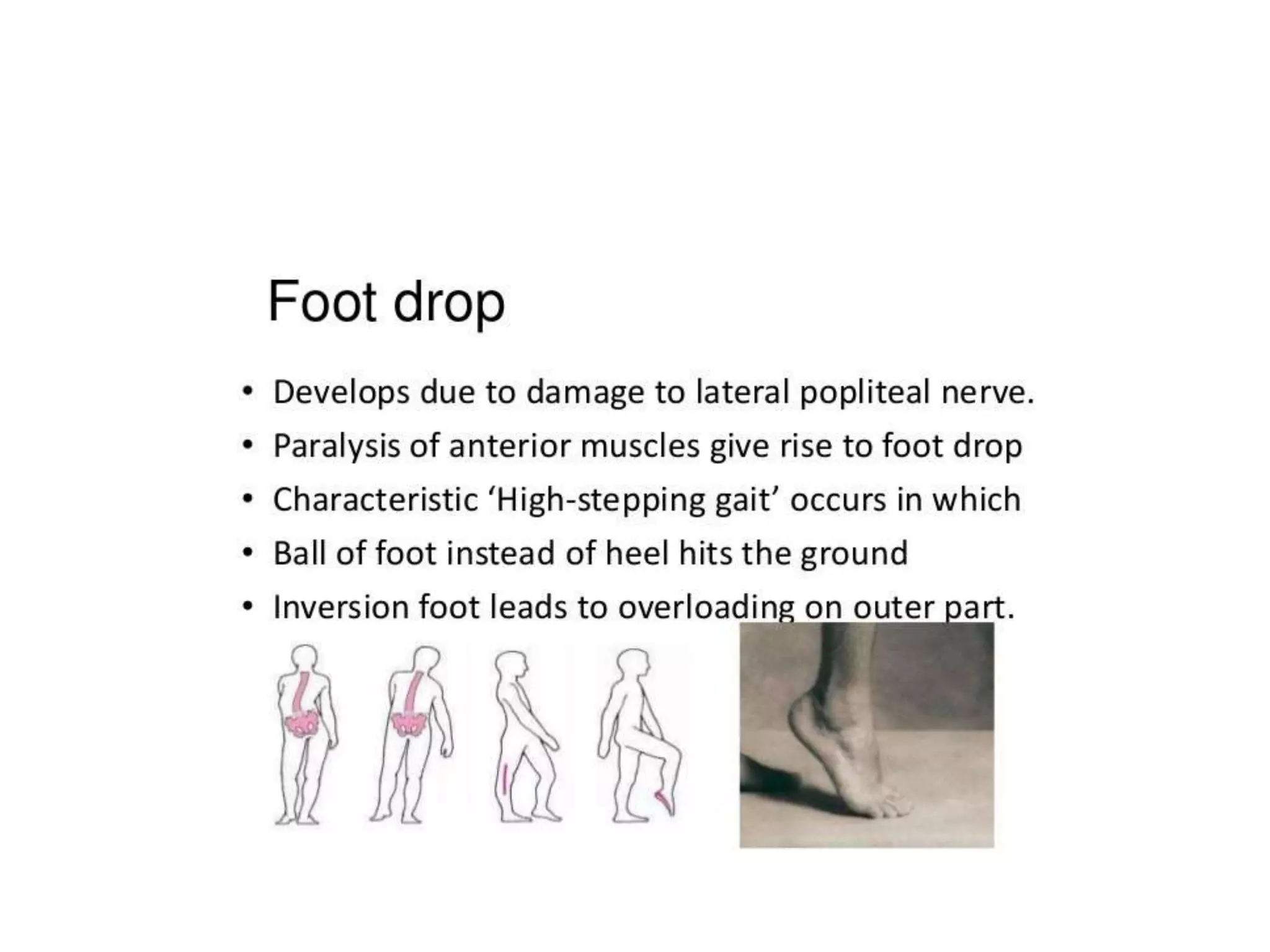 Foot drop | PPTX