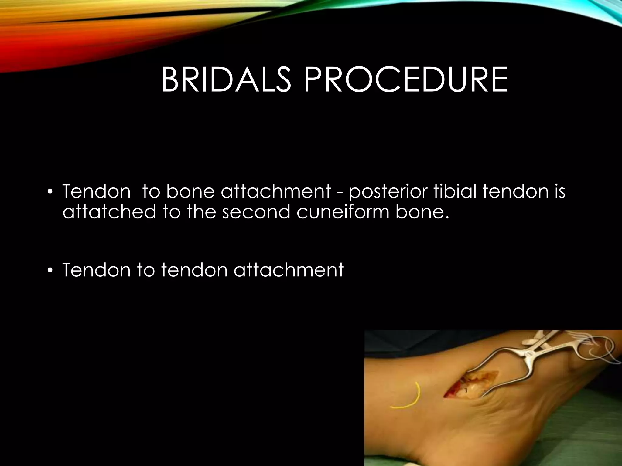 BRIDALS PROCEDURE 
• Tendon to bone attachment - posterior tibial tendon is 
attatched to the second cuneiform bone. 
• Tendon to tendon attachment 
 