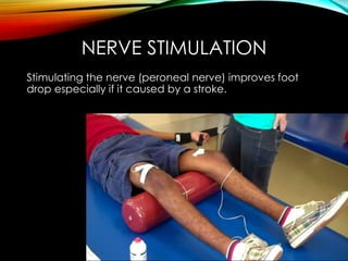 NERVE STIMULATION 
Stimulating the nerve (peroneal nerve) improves foot 
drop especially if it caused by a stroke. 
 