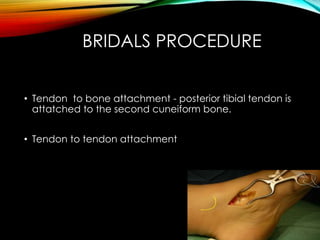 BRIDALS PROCEDURE 
• Tendon to bone attachment - posterior tibial tendon is 
attatched to the second cuneiform bone. 
• Tendon to tendon attachment 
 