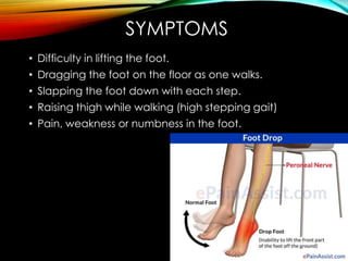 SYMPTOMS 
• Difficulty in lifting the foot. 
• Dragging the foot on the floor as one walks. 
• Slapping the foot down with each step. 
• Raising thigh while walking (high stepping gait) 
• Pain, weakness or numbness in the foot. 
 