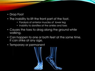 Foot Drop  Drop Foot