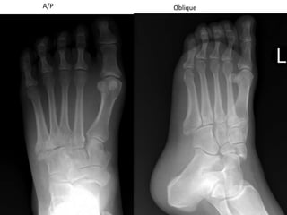 Foot fractures