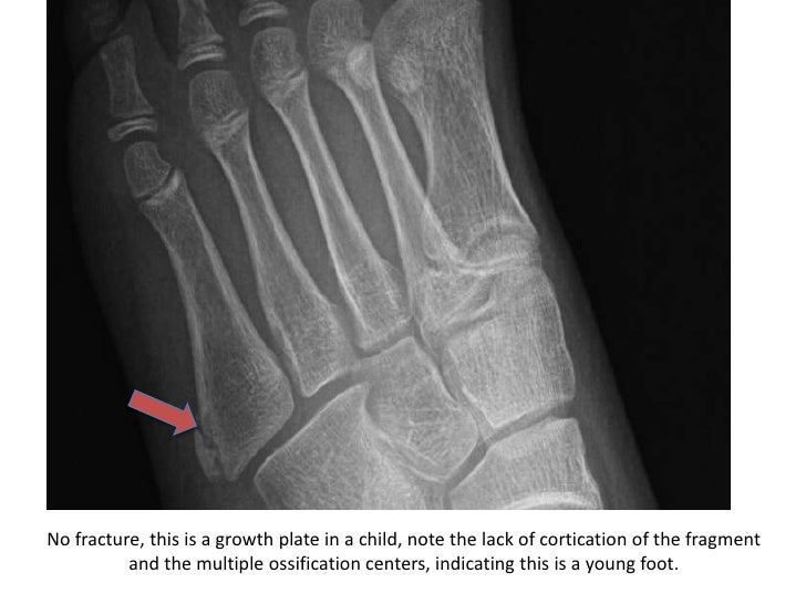 foot-fractures