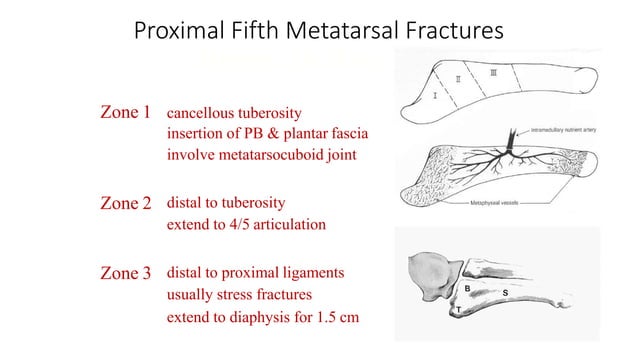 Torg Classification Foot fractures -meta tarsal fractures | PPTX