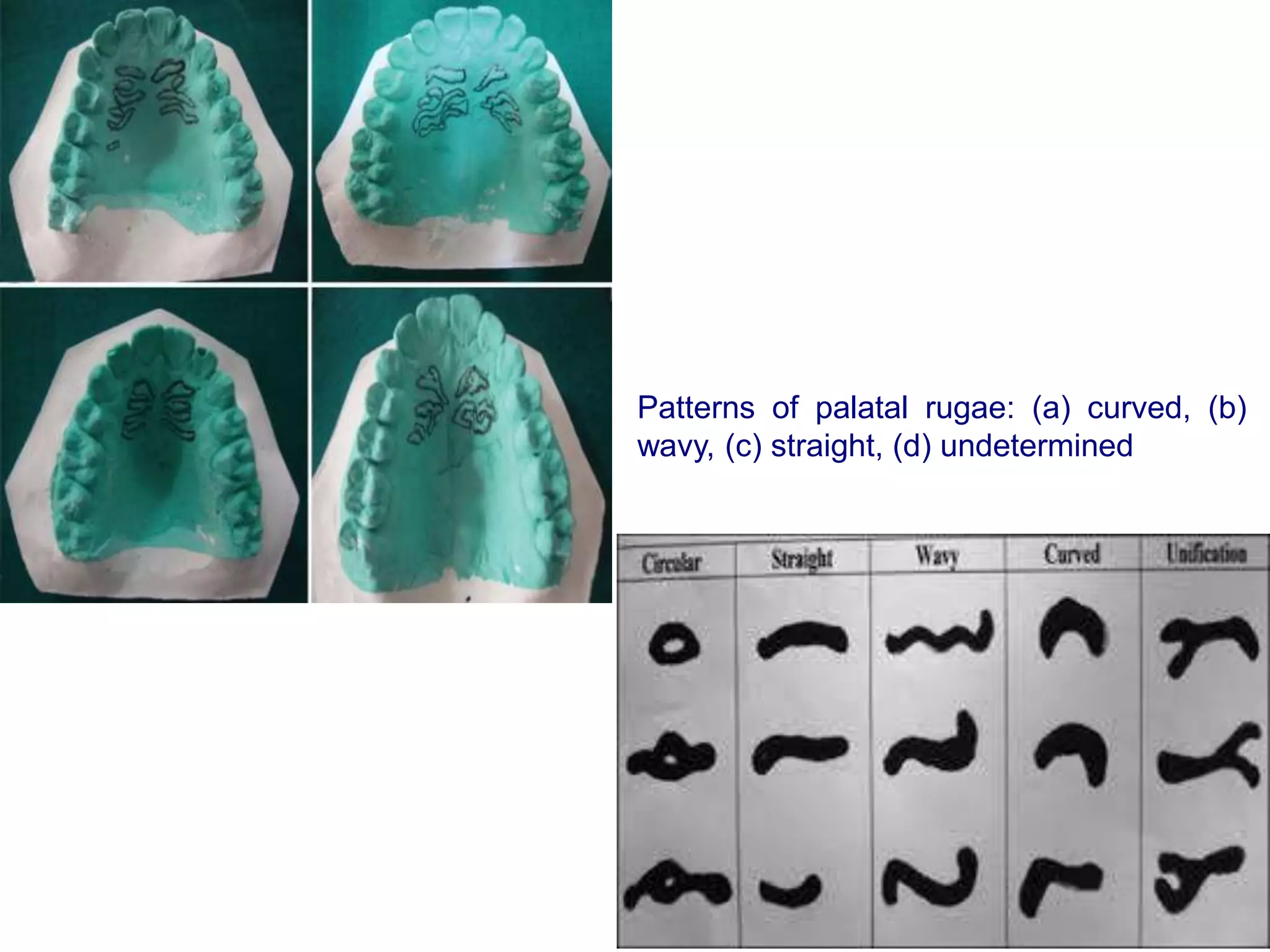 Patterns of palatal rugae: (a) curved, (b)
wavy, (c) straight, (d) undetermined
 