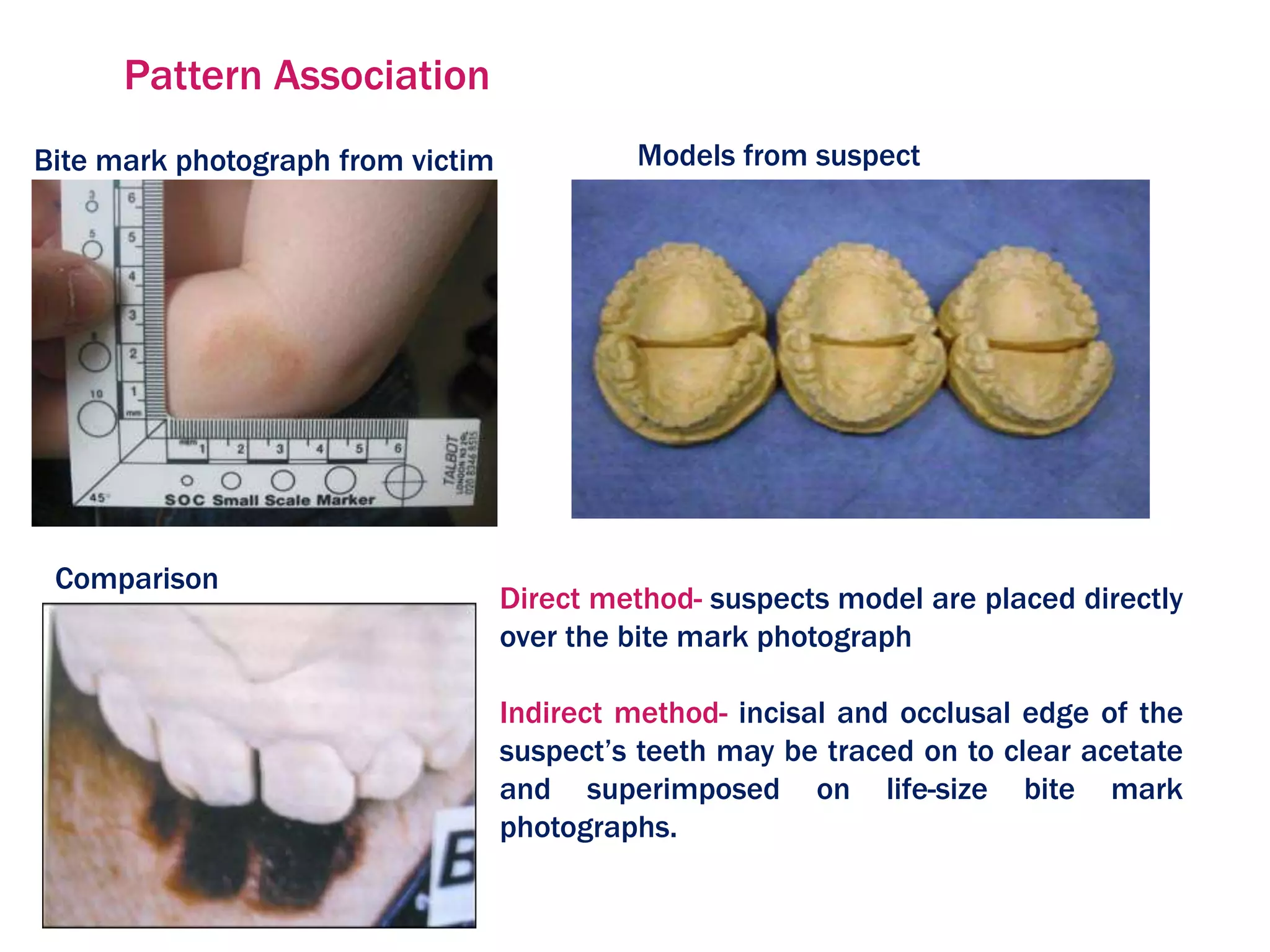 Pattern Association
Bite mark photograph from victim Models from suspect
Comparison
Direct method- suspects model are placed directly
over the bite mark photograph
Indirect method- incisal and occlusal edge of the
suspect’s teeth may be traced on to clear acetate
and superimposed on life-size bite mark
photographs.
 