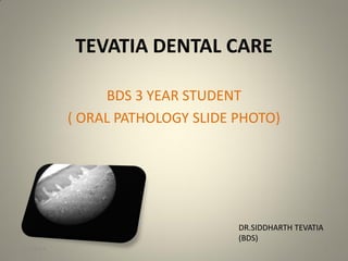 TEVATIA DENTAL CARE
BDS 3 YEAR STUDENT
( ORAL PATHOLOGY SLIDE PHOTO)
DR.SIDDHARTH TEVATIA
(BDS)
5/27/2014 1
 