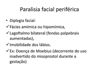 Paralisia facial periférica
• Diplegia facial:
Fácies amímica ou hipomímica,
Lagoftalmo bilateral (fendas palpebrais
aumentadas),
Imobilidade dos lábios.
Ex: Doença de Moebius (decorrente do uso
inadvertido do misoprostol durante a
gestação)
 