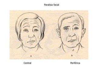 Paralisia facial
Central Periférica
 