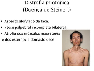 Distrofia miotônica
(Doença de Steinert)
• Aspecto alongado da face,
• Ptose palpebral incompleta bilateral,
• Atrofia dos músculos masseteres
e dos esternocleidomastoideos.
 