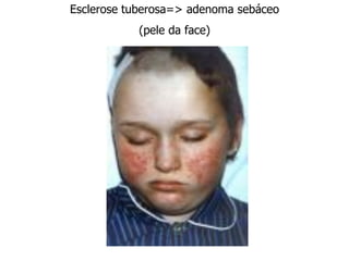 Esclerose tuberosa=> adenoma sebáceo
(pele da face)
 