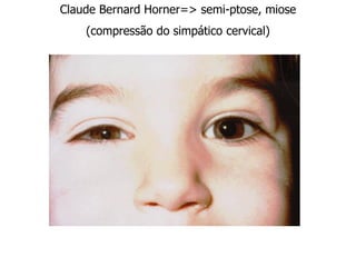 Claude Bernard Horner=> semi-ptose, miose
(compressão do simpático cervical)
 