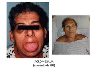 ACROMEGALIA
(aumento de GH)
 
