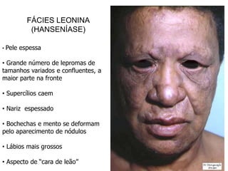 FÁCIES LEONINA
(HANSENÍASE)
• Pele espessa
• Grande número de lepromas de
tamanhos variados e confluentes, a
maior parte na fronte
• Supercílios caem
• Nariz espessado
• Bochechas e mento se deformam
pelo aparecimento de nódulos
• Lábios mais grossos
• Aspecto de “cara de leão”
 