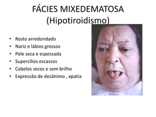 FÁCIES MIXEDEMATOSA
(Hipotiroidismo)
• Rosto arredondado
• Nariz e lábios grossos
• Pele seca e espessada
• Supercílios escassos
• Cabelos secos e sem brilho
• Expressão de desânimo , apatia
 