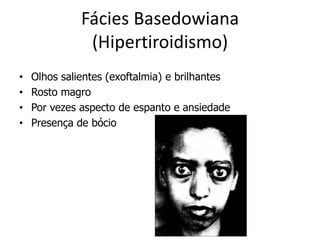 Fácies Basedowiana
(Hipertiroidismo)
• Olhos salientes (exoftalmia) e brilhantes
• Rosto magro
• Por vezes aspecto de espanto e ansiedade
• Presença de bócio
 