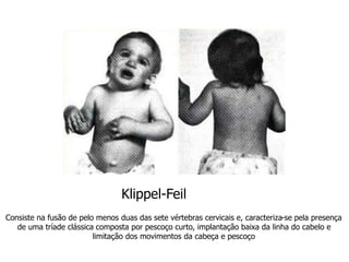 Consiste na fusão de pelo menos duas das sete vértebras cervicais e, caracteriza-se pela presença
de uma tríade clássica composta por pescoço curto, implantação baixa da linha do cabelo e
limitação dos movimentos da cabeça e pescoço
Klippel-Feil
 