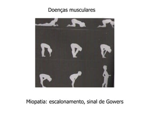 Miopatia: escalonamento, sinal de Gowers
Doenças musculares
 