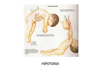 HIPOTONIA
 