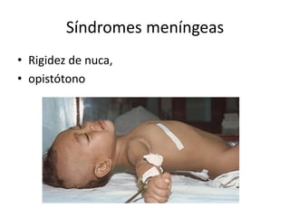 Síndromes meníngeas
• Rigidez de nuca,
• opistótono
 
