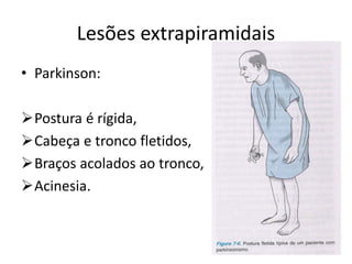 Lesões extrapiramidais
• Parkinson:
Postura é rígida,
Cabeça e tronco fletidos,
Braços acolados ao tronco,
Acinesia.
 