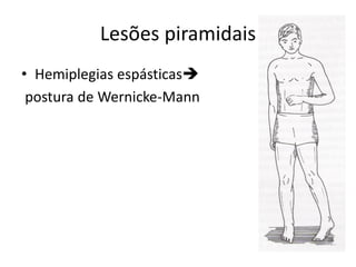 Lesões piramidais
• Hemiplegias espásticas
postura de Wernicke-Mann
 