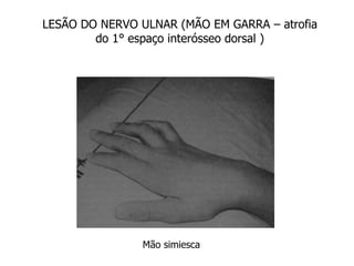 LESÃO DO NERVO ULNAR (MÃO EM GARRA – atrofia
do 1° espaço interósseo dorsal )
Mão simiesca
 