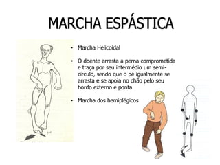 • Marcha Helicoidal
• O doente arrasta a perna comprometida
e traça por seu intermédio um semi-
círculo, sendo que o pé igualmente se
arrasta e se apoia no chão pelo seu
bordo externo e ponta.
• Marcha dos hemiplégicos
 