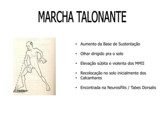 • Aumento da Base de Sustentação
• Olhar dirigido pra o solo
• Elevação súbita e violenta dos MMII
• Recolocação no solo inicialmente dos
• Calcanhares
• Encontrada na Neurosífilis / Tabes Dorsalis
 