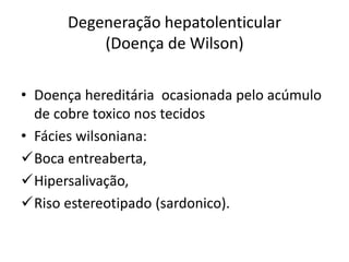 Degeneração hepatolenticular
(Doença de Wilson)
• Doença hereditária ocasionada pelo acúmulo
de cobre toxico nos tecidos
• Fácies wilsoniana:
Boca entreaberta,
Hipersalivação,
Riso estereotipado (sardonico).
 