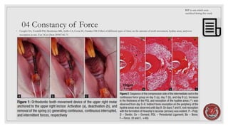 04 Constancy of Force
◦ Cuoghi OA, Tondelli PM, Mendonça MR, Aiello CA, Costa SC, Tanaka OM. Effect of different types of force on the amount of tooth movement, hyaline areas, and root
resorption in rats. Eur J Gen Dent 2018;7:66-71.
RIP to rats which were
sacrificed during this study
 