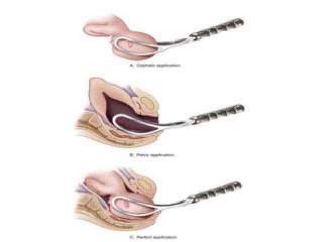 Using Forceps During Delivery FORCEPS DELIVERY............ | PPTX