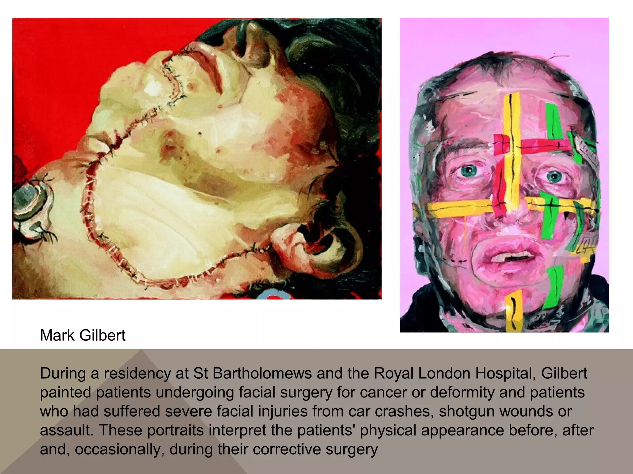 Mark Gilbert
During a residency at St Bartholomews and the Royal London Hospital, Gilbert
painted patients undergoing facial surgery for cancer or deformity and patients
who had suffered severe facial injuries from car crashes, shotgun wounds or
assault. These portraits interpret the patients' physical appearance before, after
and, occasionally, during their corrective surgery
 